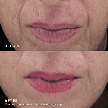 Needle-less® Serum